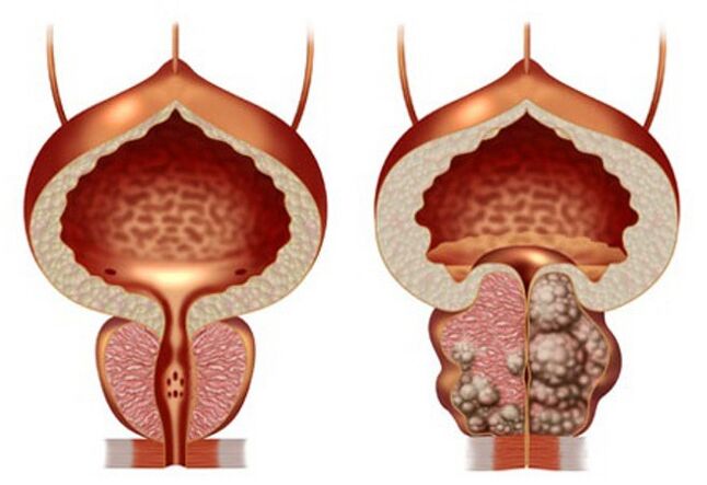 sağlıklı prostat ve prostat adenomu
