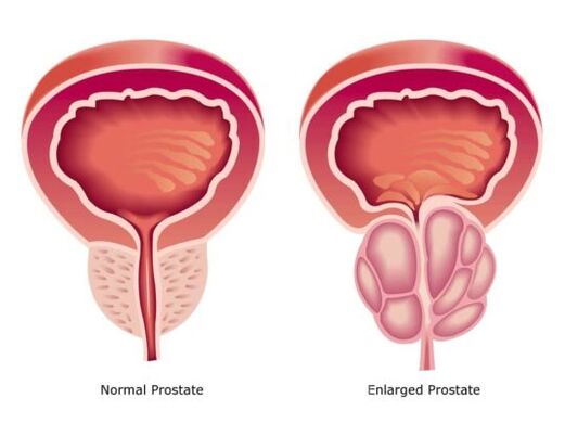 Normal ve genişlemiş prostat