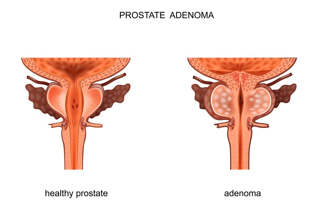 sağlıklı prostat ve adenomlu